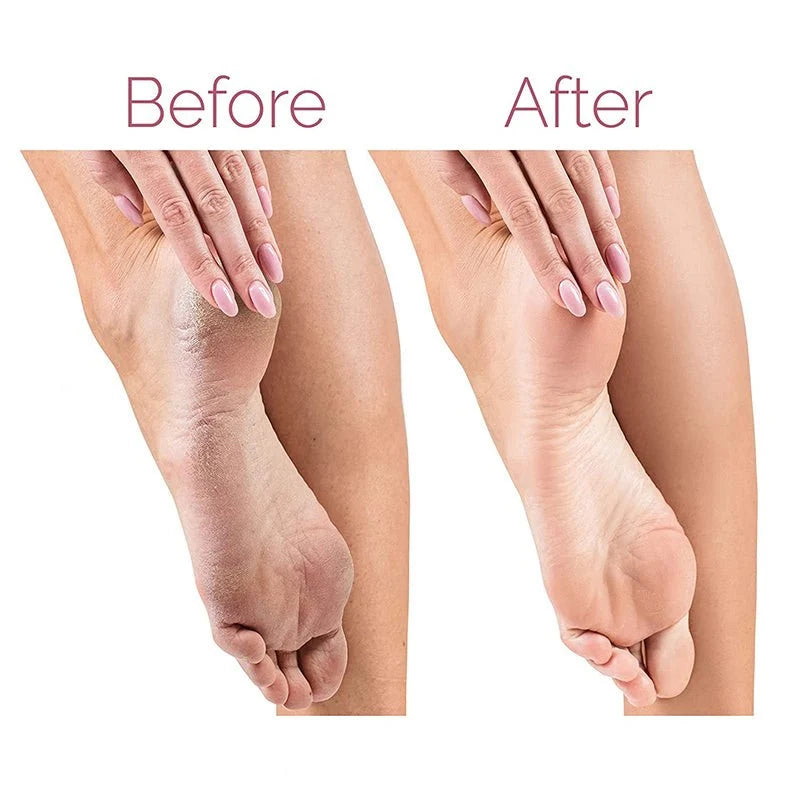 Electric Foot Callus Remover | عناية ناعمة للقدمين